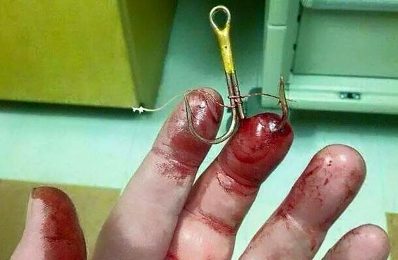 bloody fishing hook in finger