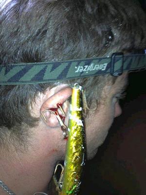 fishing hook injury