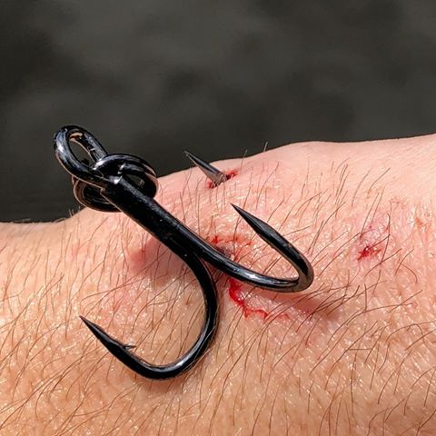 treble hook stuck in hand