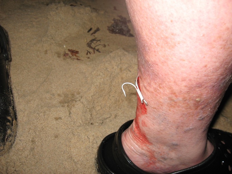 fish hook in the leg
