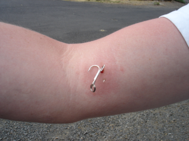 fish hook stuck in arm