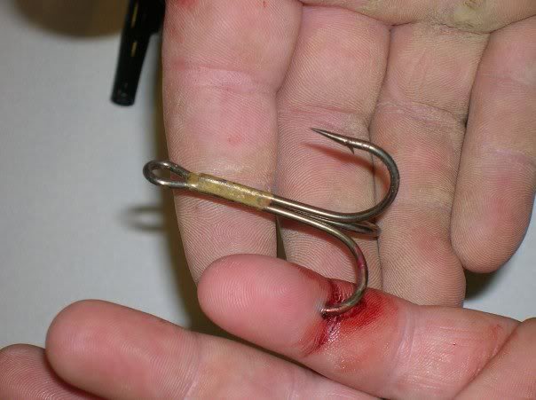 fish hook in finger