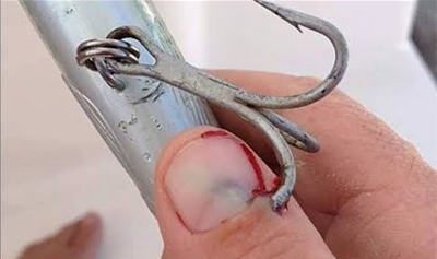 fishing hook in the thumb