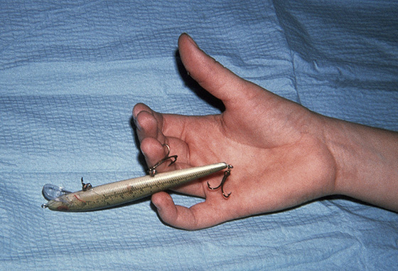 fish hook removal in hospital