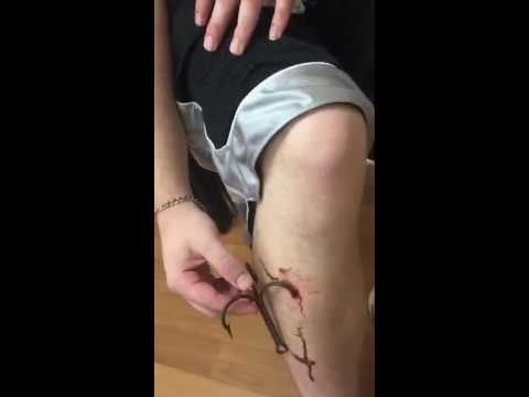alligator hook stuck in leg