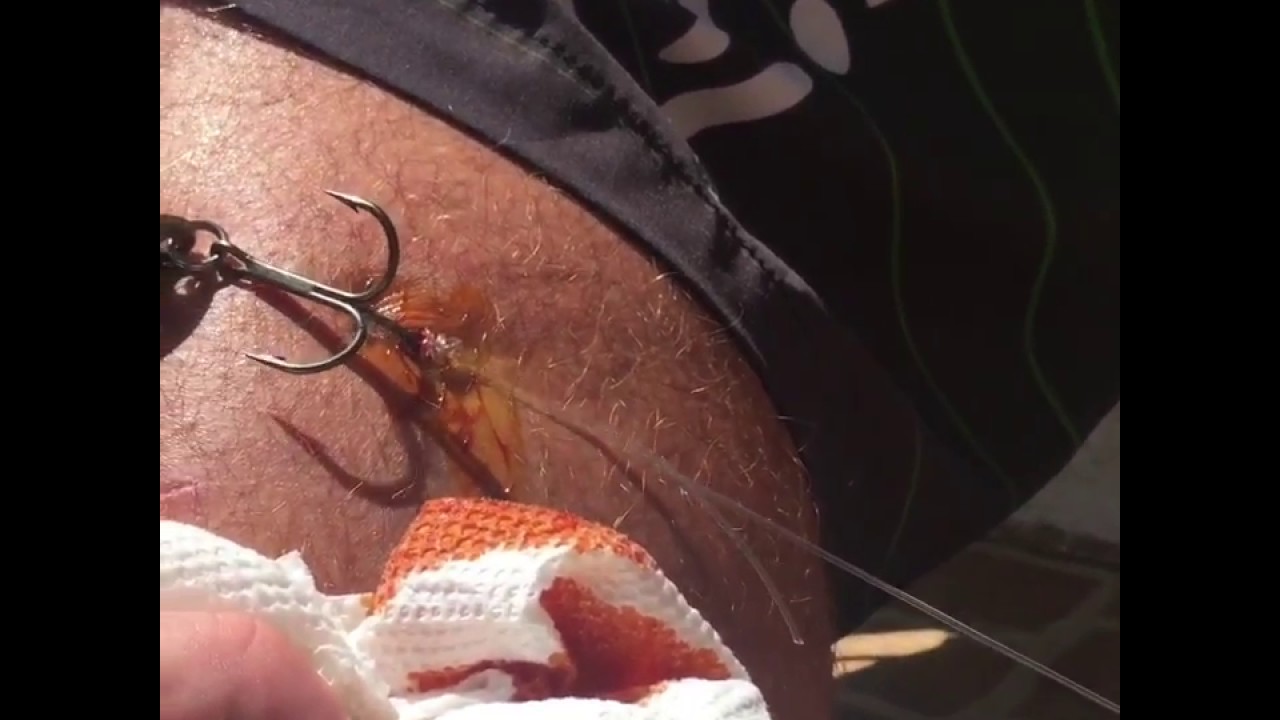 fish hook in thigh