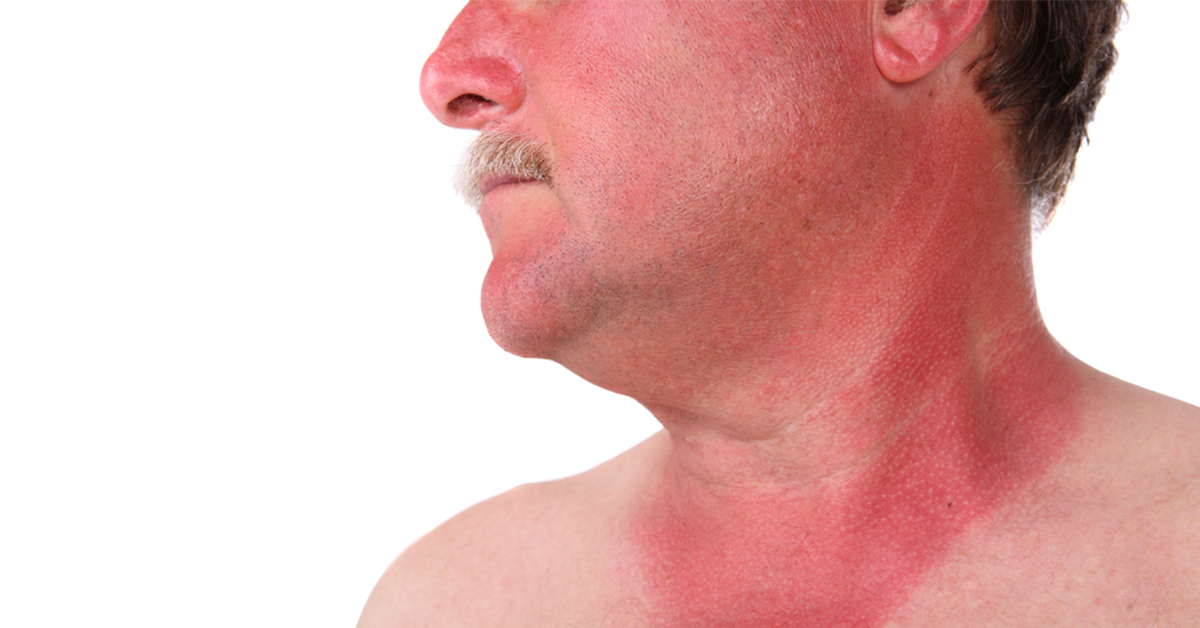 http://man%20with%20sunburn%20on%20face