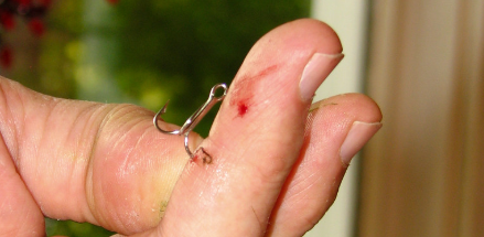 treble hook finger injury