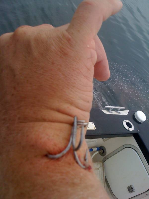 treble hook stuck in hand